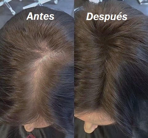 Resultado de crecimiento de cabello tras 15 días
