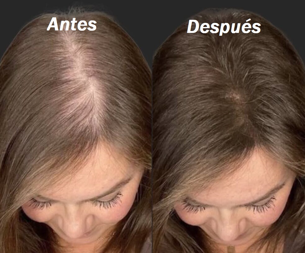 Testimonio visual recuperación de densidad capilar