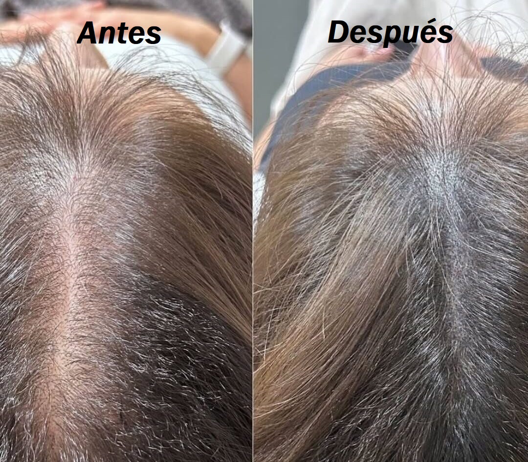 Antes y después del kit de crecimiento capilar natural